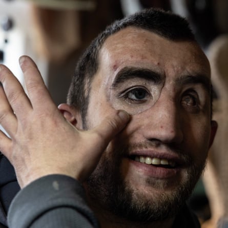 The prosthetic eye is held up against Onopriienko’s face