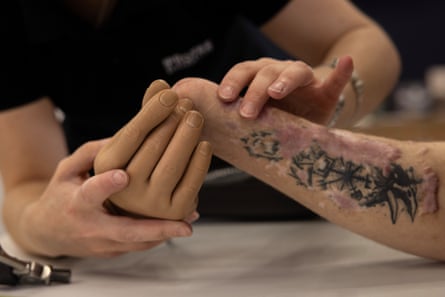 A person holds a prosthetic hand up to Romantsov’s arm
